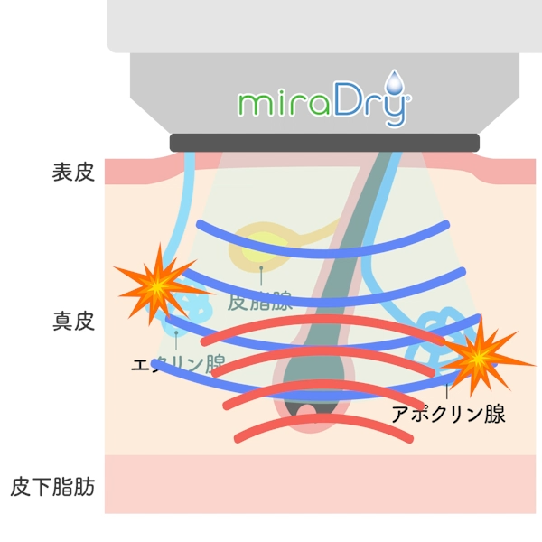 ミラドライで破壊された汗腺は復活しない