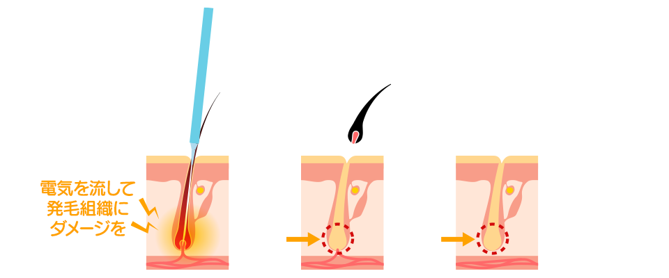 熱破壊式脱毛のイメージ
