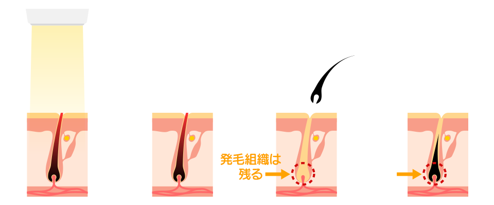 熱破壊式脱毛のイメージ