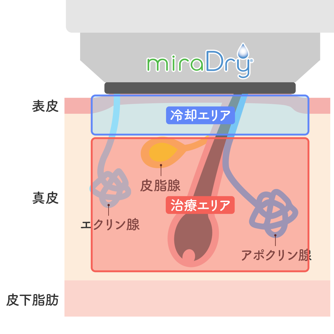 ミラドライ_step3